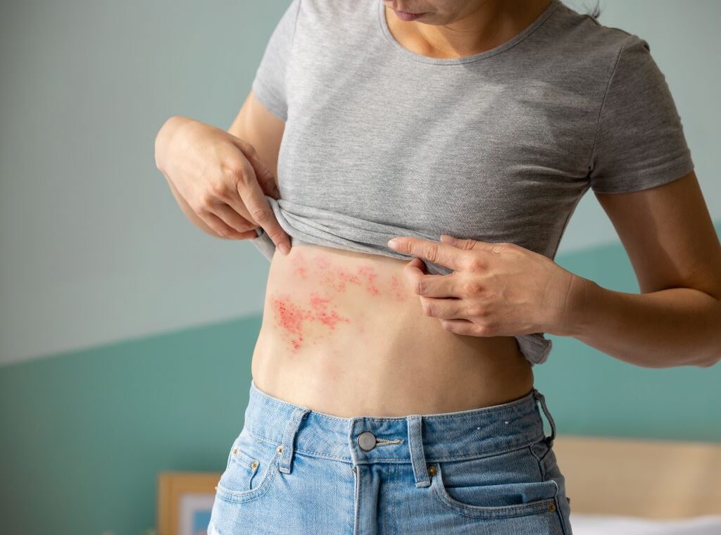 zoster herpes